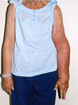 Before Lymphedema Therapy